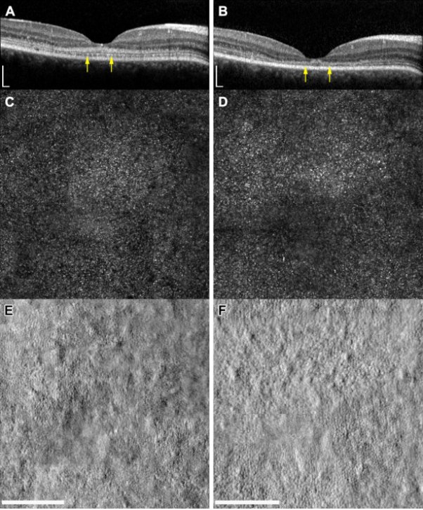 UCL_Retina's tweet photo. Early Patterns of Macular Degeneration in ABCA4-Associated Retinopathy 
#Stargardt #AOSLO #OCT #MacularDystrophy 
https://t.co/Frut08k92S https://t.co/y0xBKjSEie