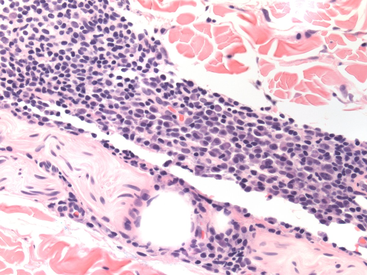 Artur Zembowicz M.D. (@drzembowicz) on Twitter photo True gem. Lyme disease. Perineural plasma cell rich infiltrate. Organisms look more beaded under oil than twisted slender rods. Maybe use <a href="/Dermpedia/">Dermpedia Courses</a> #dermpath #pathology #pathologists True gem. Lyme disease. Perineural plasma cell rich infiltrate. Organisms look more beaded under oil than twisted slender rods. Maybe use <a href="/Dermpedia/">Dermpedia Courses</a> #dermpath #pathology #pathologists