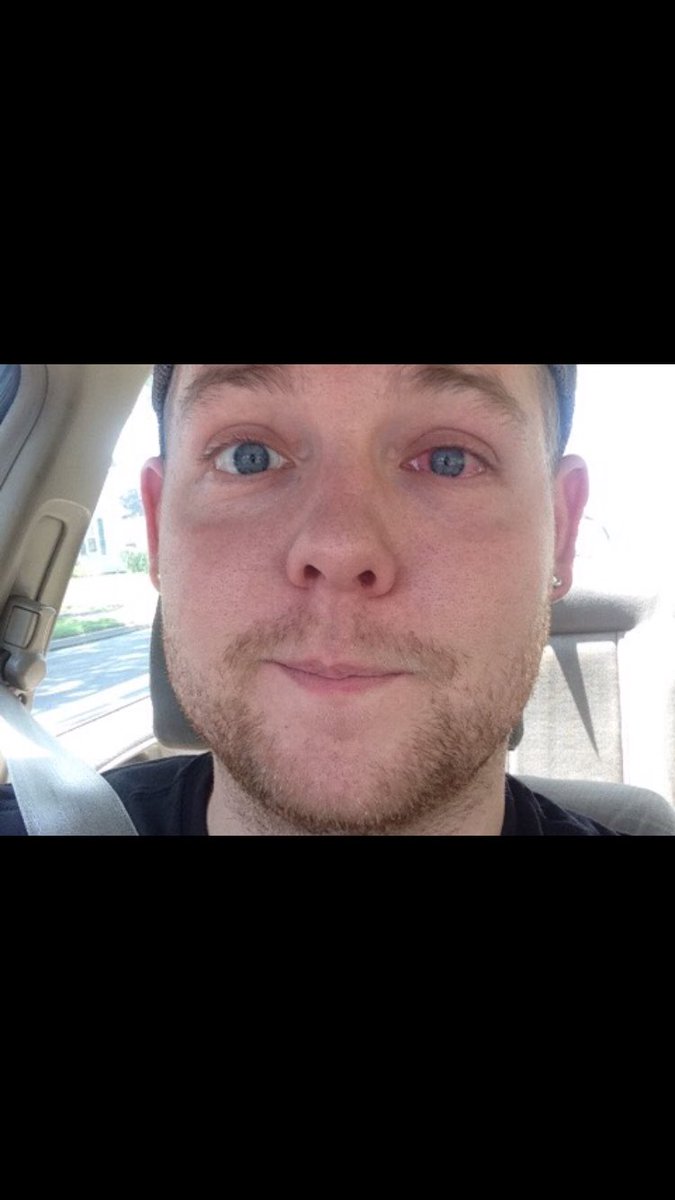 If anyone remembers our “She’s Kinda Hot” cover video with <a href="/TheWeekendRiot/">The Weekend Riot</a> and ever wondered why I wore sunglasses the entire video and looked like a douche, this is why...I had a terrible protein infection from accidentally falling asleep with my contacts in the night before.