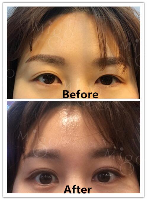 Migo_Clinic's tweet image. Bigger eyes after endotine forhead lift! #migo整形外科 #migoclinic #migoplasticsurgery #instabeauty #foreheadlift #anti-aging #eyesurgery #endotine #beforeandafter #medical #drkohanwoong #korea #seoul #plasticsurgery #travel #tourism #韩国整形 #安多泰提升 #额头提升 #整形外科