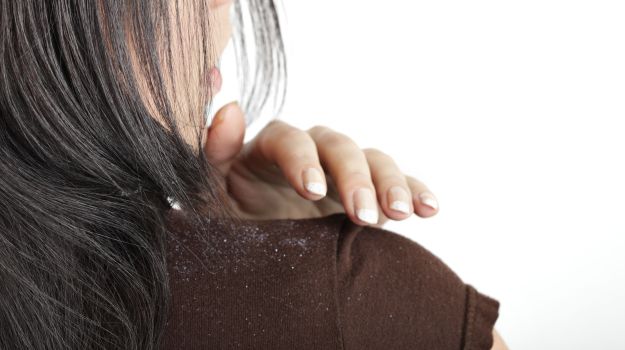 URHealthConcern's tweet photo. We are here to share a secret with you, which is going to change your life, by showing you the best way to get rid of that stubborn dandruff in your hair, permanently. 
Read On: https://t.co/3T6rDKTFiK
#getRidOfDandruff #DandruffFreeHair https://t.co/xFCyGBQzj2