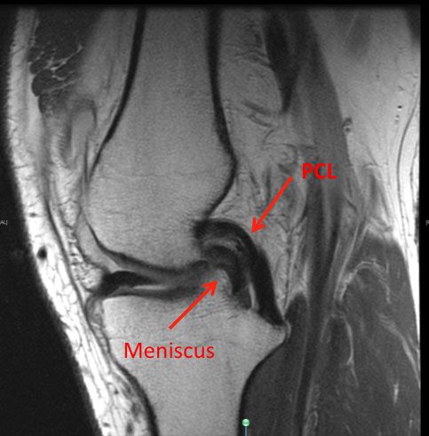 drprovencher's tweet photo. If #PCLsurgery is necessary to return full function and stability to the knee joint, Dr. Provencher will reconstruct the torn ligament with a graft using an arthroscopic approach https://t.co/hfhRvzMjVp https://t.co/Ni08ke4spN