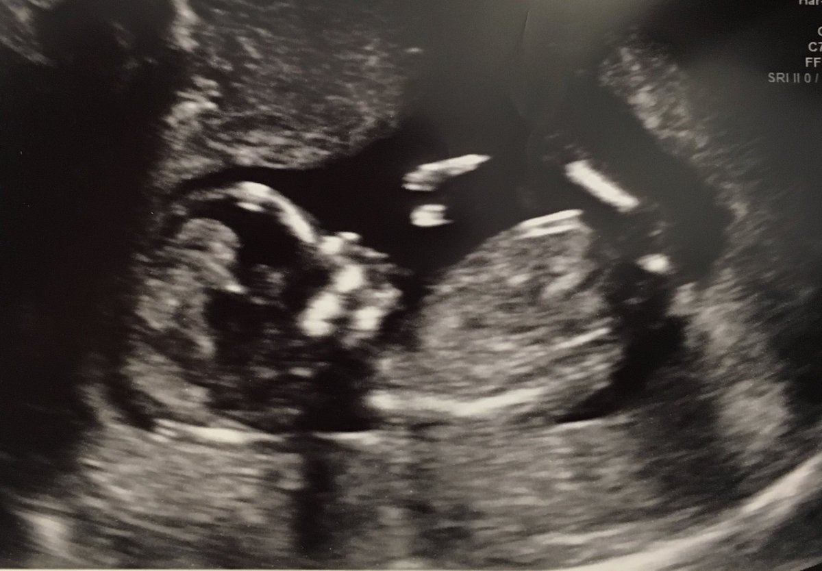 Excited to announce my wife and I will be expecting our first child this summer!