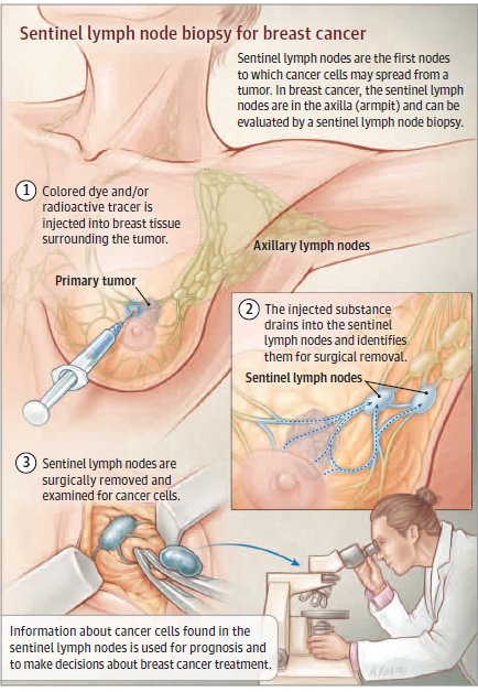 Patient page explains clinical significance of sentinel lymph node mapping for early stage #BreastCancer (or potentially other cancers) &amp; how it’s performed. ja.ma/2CAWDLu #BCSM