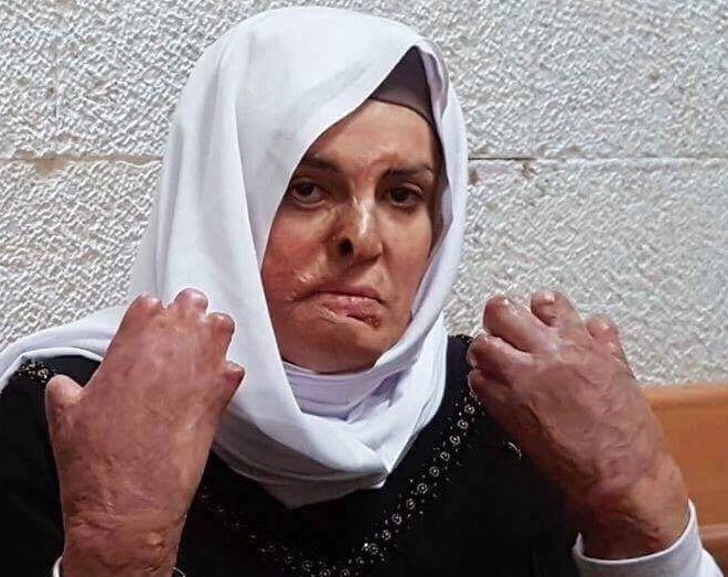 humanmovieteam_'s tweet photo. İsrail askeri kontrol noktasında aracındaki mutfak tüpünün patlamasıyla yüzü yanan ve bir İsrail askeri de yaralandığı için 'kasten yapıldığı' iddiasıyla 11 yıl hapis cezası alan Filistinli #IsraaJaabis'in gerekli tedaviyi alabilmesi için serbest bırakılması gerekiyor. #freeisra https://t.co/4rUlXpAurK