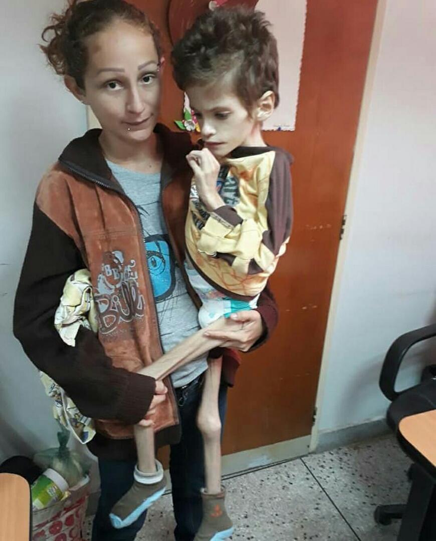 AnonimusCR's tweet photo. #12Ene
Estas fotos NO son del Holocausto Nazi, ni de Sudáfrica, ni de después de la Segunda Guerra Mudial . Ésta foto es actual, en Venezuela. una Sra con su hijo en Valencia Estado Carabobo, el niño murió por desnutrición, esto es inhumano. HAMBRUNA EN VZLA. https://t.co/2Mib38c2cM