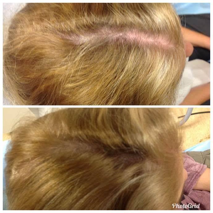 midwestaging's tweet image. The results of PRP therapy on one of our patients! The application of Platelet-Rich Plasma causes hair follicles to become larger and healthier, thus producing more hair growth. 💁 

#HairGrowth #MedSpa #Beauty