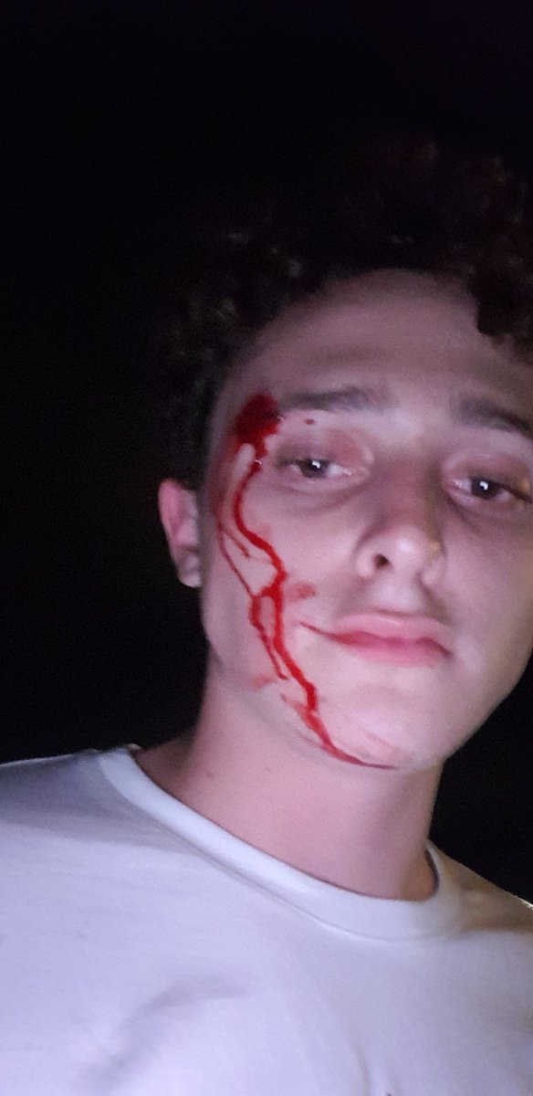 big__daddy_kane's tweet photo. You should see the other guy haha it was a pole https://t.co/GWXtrQTRvo