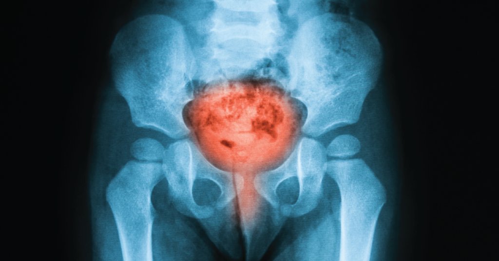 WebMD's tweet image. Interstitial cystitis causes ongoing pain and is related to inflammation of the bladder. What to know: wb.md/2movGjT