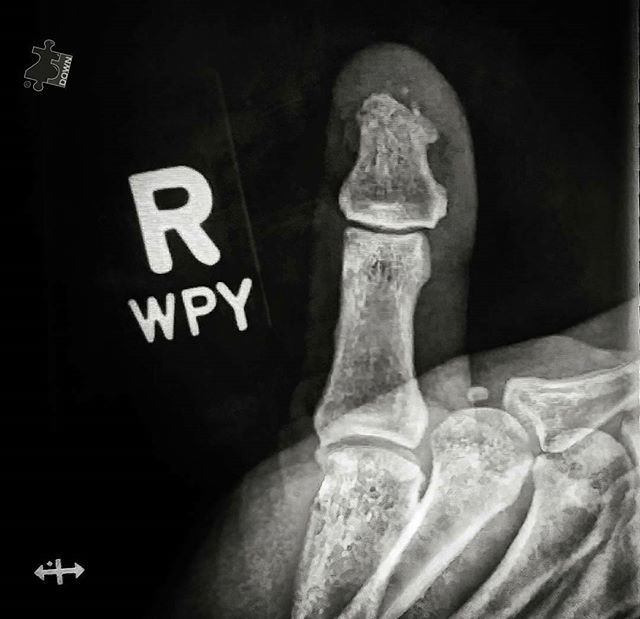 GoConstrux's tweet image. Table saws are no joke, neither was 2017! Here&apos;s to the up &amp;amp; up in 2018! 👍 #AllHealed #OnToBetterThings #ThumbsUp #JustTheTip #Reflecting #Grateful - #regrann bit.ly/2DbKeOS