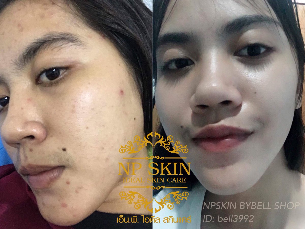 Bell3992Bell's tweet photo. รีวิวจากลูกค้าคนสวย ใช้ไนท์ครีม #NPSKIN
สวย เป๊ะเวอร์ ในราคา 350.-
สอบถาม/สั่งซื้อ/สมัครตัวแทน ทักมาเลยจ้า
https://t.co/h3vk59BM8x https://t.co/ox4b0dHSLY