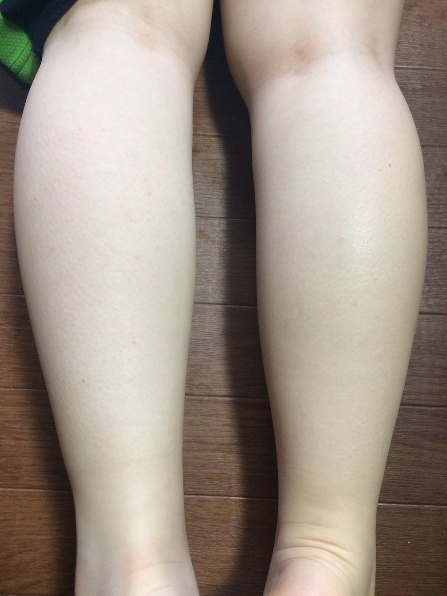 Coco Sur Twitter 妹の足をマッサージしてた 右がマッサージした後 足首とかしゅってする 私も毎日しよっと ダイエット 足マッサージ