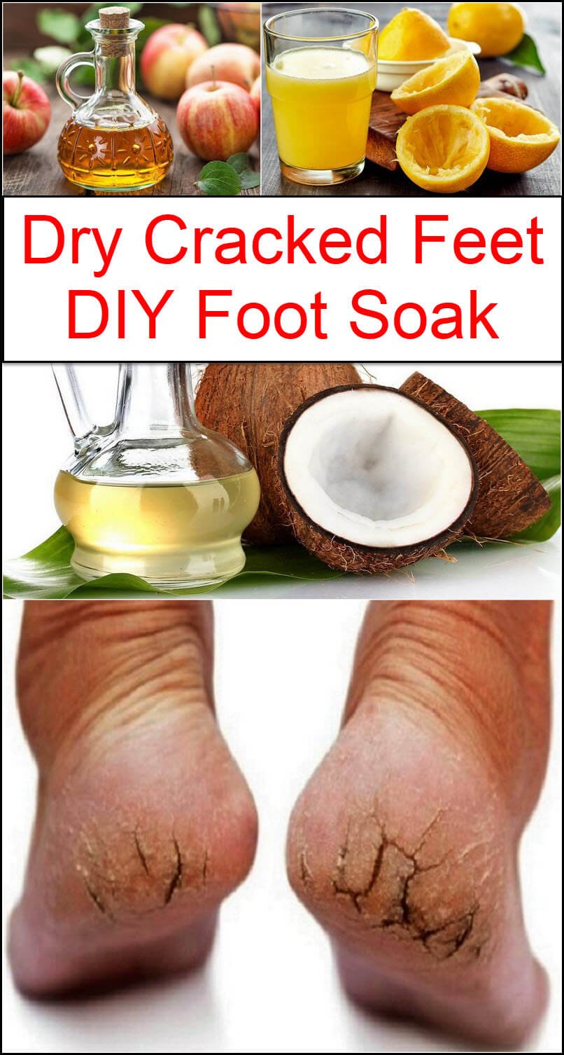 Homemade foot soak 2024 for dry feet