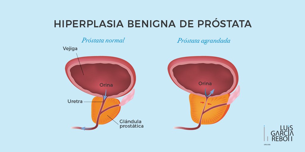que especialista trata la próstata