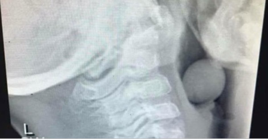 Netmums's tweet photo. Mum issues choking warning with X-ray of grape lodged in a child's airway https://t.co/9uwAE2pBzK https://t.co/PD7EZns7i0