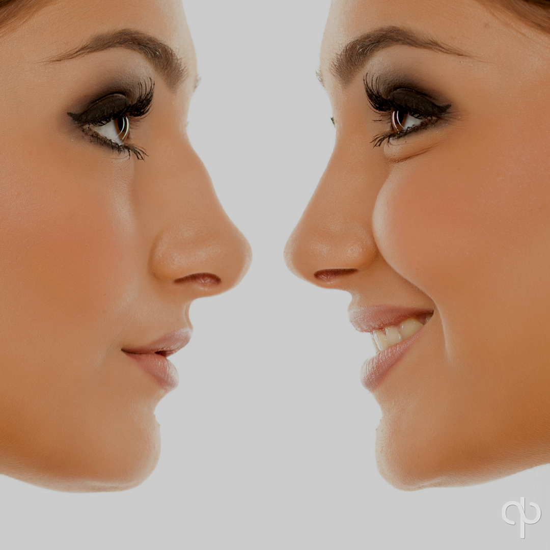 PabloPrichard's tweet photo. Each individual has his or her own personal concept of what a “perfect nose” ought to look like, in the shape and size.  Dr. Prichard works to delivers a rhinoplasty procedure that will be entirely tailor-made to fit your particular facial structure. https://t.co/uxnRuqnMH7 https://t.co/XbX1mthhgq