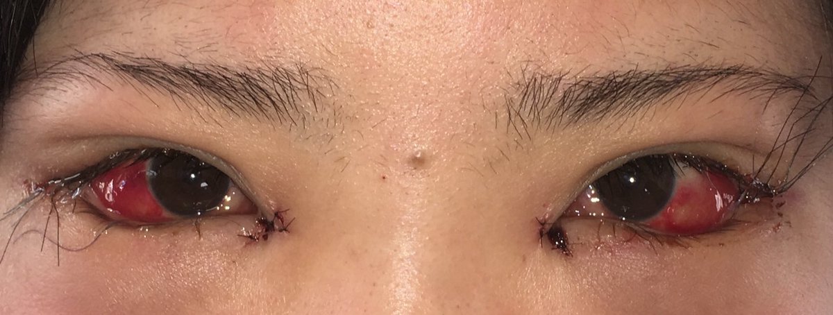 目尻切開タレ目形成dt経過 A Twitter 1月15日 目尻切開 グラマラスライン タレ目形成 ダウンタイム5日目 昼 禁酒してましたがこんなに治らないなら飲んじゃえって思って ビールを2lくらい飲んだ次の日です ちょっと治ってる 普通は6日目って白目 ぶよぶよ 治り