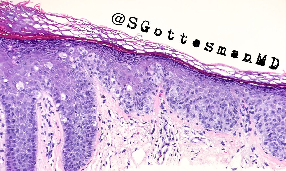 SGottesmanMD's tweet photo. Extramammary Paget’s disease: a vulvar biopsy from an 80 yo female. Often mistaken for eczema. A biopsy is essential for diagnosis. Epidermal infiltration by large, pale and atypical cells. CK7+, mucicarmine+ #dermpath #gynpath #dermatology #pathology https://t.co/IGnaFD07Gs