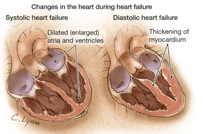 Among obese older patients with clinically stable HFPEF (heart failure with preserved ejection fraction), caloric restriction and aerobic exercise training increased peak V̇o2, but neither intervention had an effect on quality of life jamanetwork.com/journals/jama/…