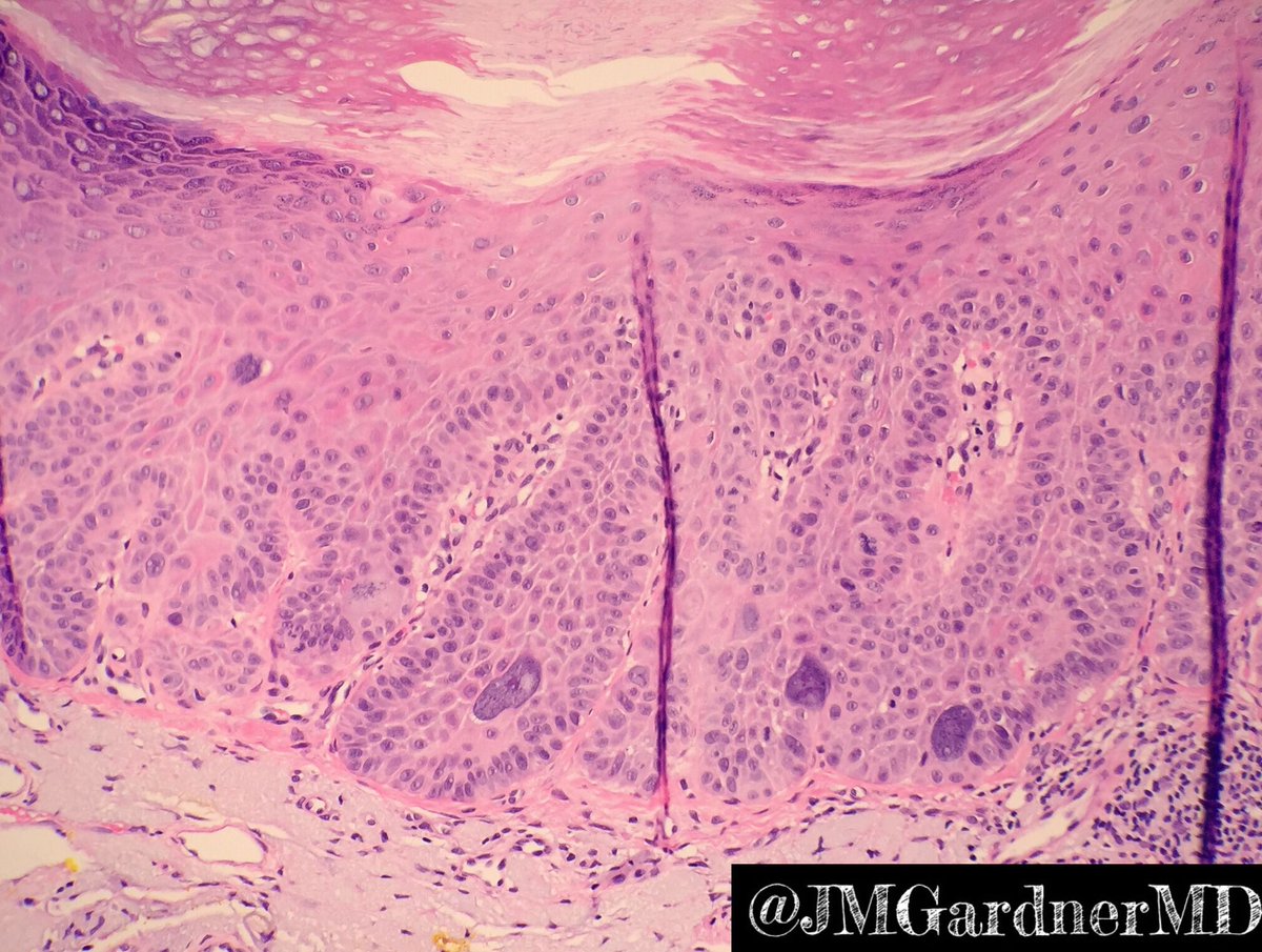 Hyperplastic Actinic Keratosis