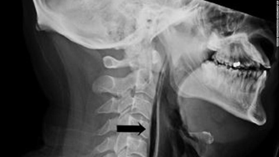 CNN's tweet image. Holding in a sneeze blew a small hole in a man's throat, according to a report. He spent two weeks in the hospital. cnn.it/2DBPWGM