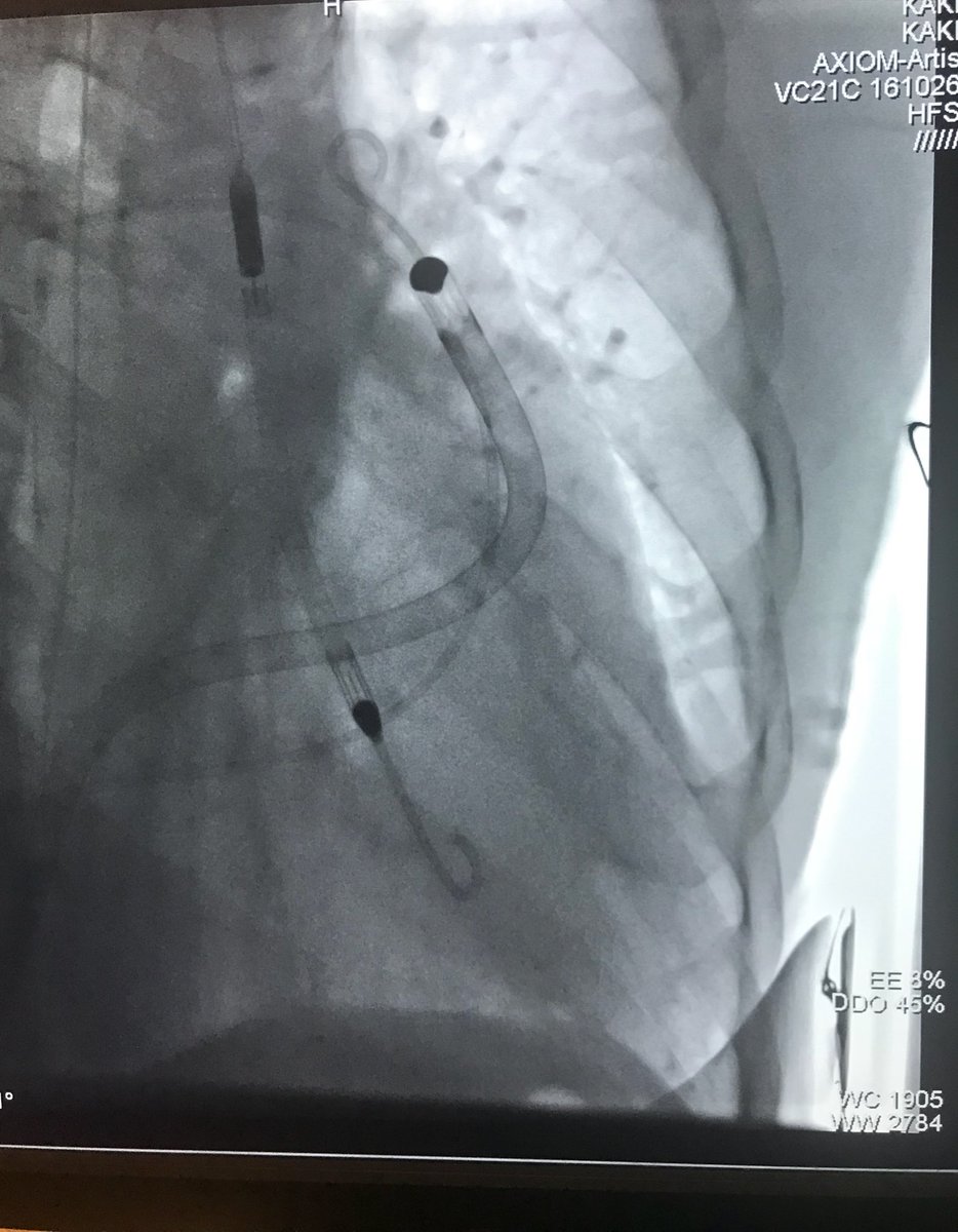 DrAmirKaki's tweet photo. Observation: Occasionally chronically dilated RVs acutely fail when the LV is unloaded. We have seen this several times and RV support has been effective. Anyone with similar experiences? #heartrecovery #BiPella #Detroit https://t.co/ck5E4E1Ayc