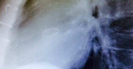 RogerHudsonCO's tweet photo. Three years ago today, I received a killer 11” scar down the center of my chest... Oh, and a new aortic valve.
No more post-op shirtless selfies... I’ve promised. #HeartValve #NotObamacare https://t.co/42jWqgMvy6