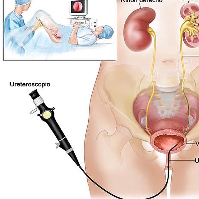 DrRACastillo's tweet photo. La ureteroscopia utiliza pequeña sonda para examinar uréteres. Uréteres los conductos que conectan los riñones a la vejiga. Este procedimiento puede ayudar a diagnosticar y tratar problemas en las vías urinarias, como por ejemplo cálculos renales.Foto: National Cancer Institute https://t.co/y1R0zbCBw2