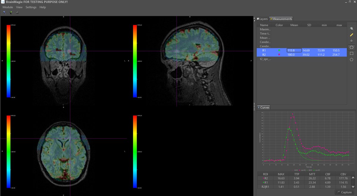 Imagilys's tweet photo. Perfusion MRI was acquired in a patient with multiple sclerosis (MS). In the MS lesion (crosshair), increased and slightly delayed perfusion can be observed (pink curve). The images were acquired and post-processed, in #BrainMagix, by Dr. @VslsKatsaros. https://t.co/KGIxr1SJao
