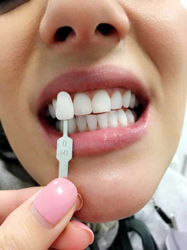 fbabatsikos's tweet photo. “My teeth are as WHITE as the snow ❄️ outside” 😁✨ #cosmeticdentist #makeover #dentist #dentistry #cosmetic #killersmiles #smilemakeover #newyear #nofilters #smilemakeover #smile #torontodentist #teeth 
#whitening #beauty #sexy #firstimpression #teethwhitening #topchoiceawards https://t.co/Ed8zcNv5we