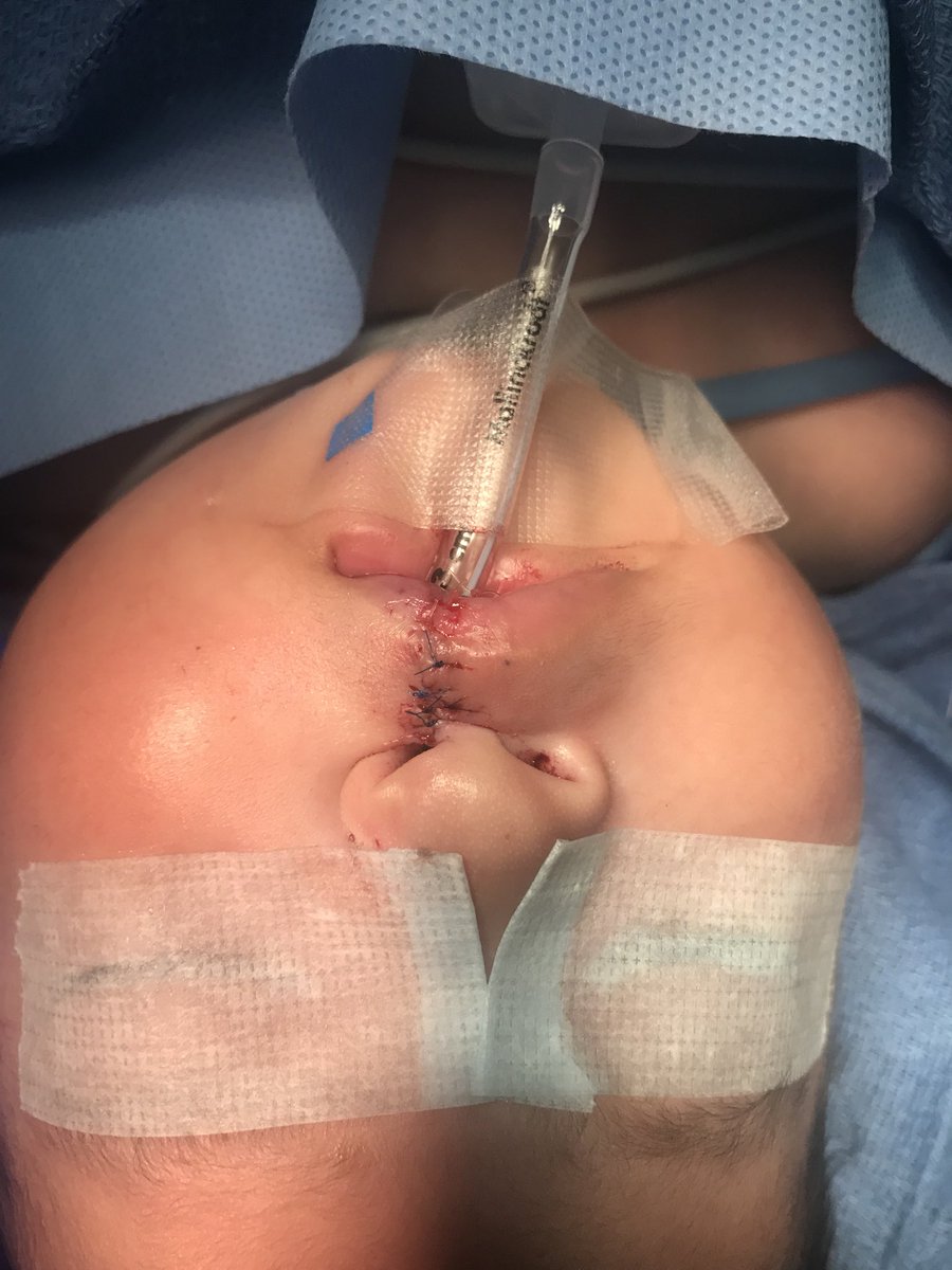 Plasticsdoc's tweet image. Cleft Lip and palate surgery in Peru.