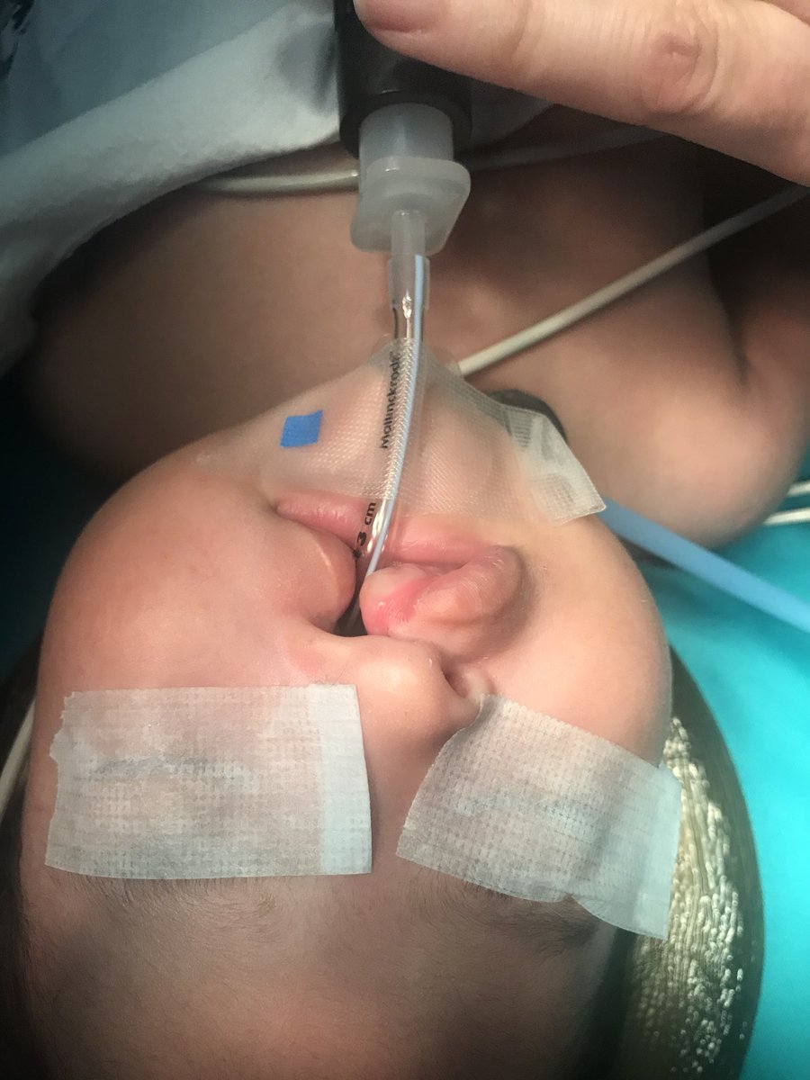 Plasticsdoc's tweet image. Cleft Lip and palate surgery in Peru.