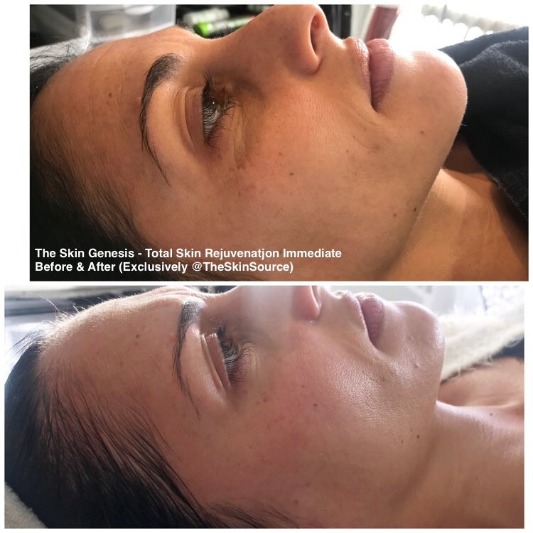 TheSkinSource's tweet image. ACHIEVE FLAWLESS, RADIANT &amp;amp; GLOWING SKIN 
Book Now! 
(914)979-1721

#skincare #skincareroutine #flawlessskin #flawless #beauty #beautyblogger #2018 #newyearnewme #trending #exclusive #westchester #yonkers #stamford  #AntiAging #transformationtuesday #youthfulskin #glow