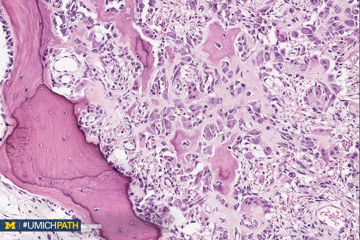 Osteoid Osteoma Histology