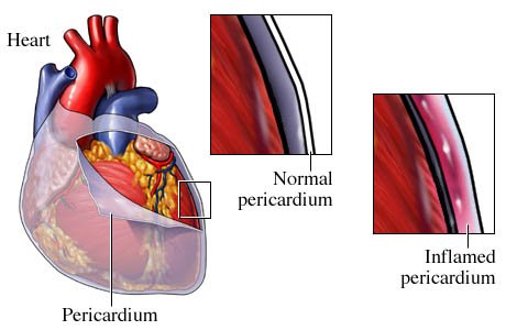 Acute Pericarditis is a well-recognised cause of chest pain and accounts for 5% of  non-ischaemic chest pain presentations to the ED ow.ly/4nmS30hFaf1