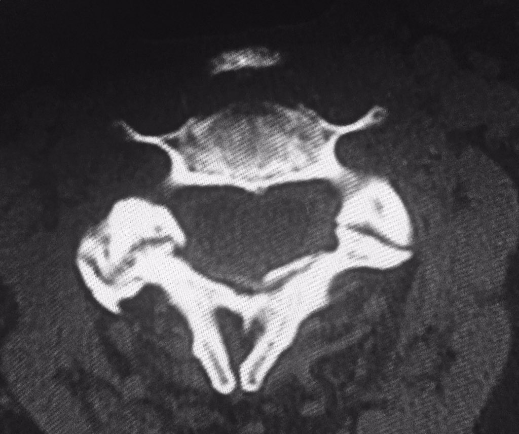 DavidZodda's tweet photo. How bad is this flu season? Elderly patient with influenza coughed so hard she fractured C2. Yeah, flu season is pretty bad! #Hangmans https://t.co/E3LZgvXLNF