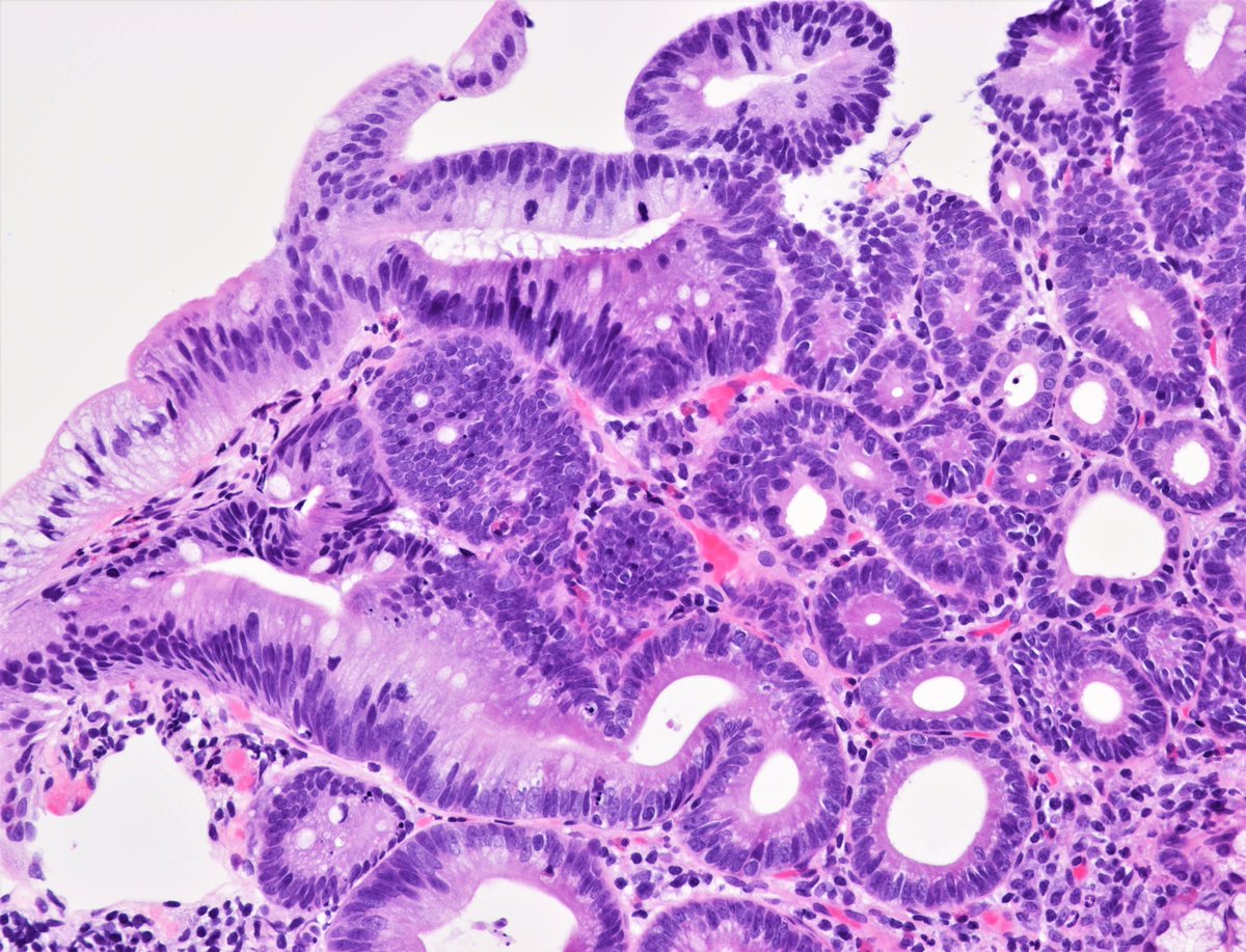 Patholwalker's tweet photo. Duodenal intraepithelial dysplasia. Duodenum, biopsy. Endoscopic images (white and NBI) and HE stain. #pathologists #GIpath https://t.co/kjdJdlu4w8