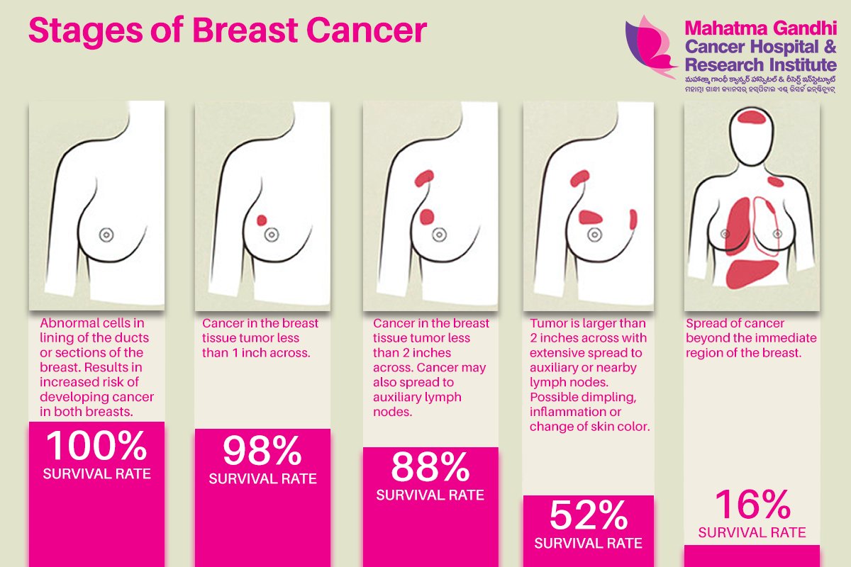 Symptoms And Complications To Understanding Breast Cancer Herxheim De