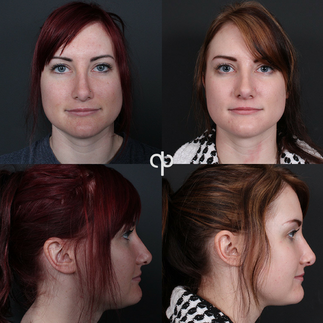 PabloPrichard's tweet photo. "I would like to change the shape and size of my nose but I still want to look the same." This is the most common request from my rhinoplasty patients. This patient wanted her nose straightened out and the tip of her nose to be shorter to provide a more feminine look. https://t.co/Nxv4Ugmkla