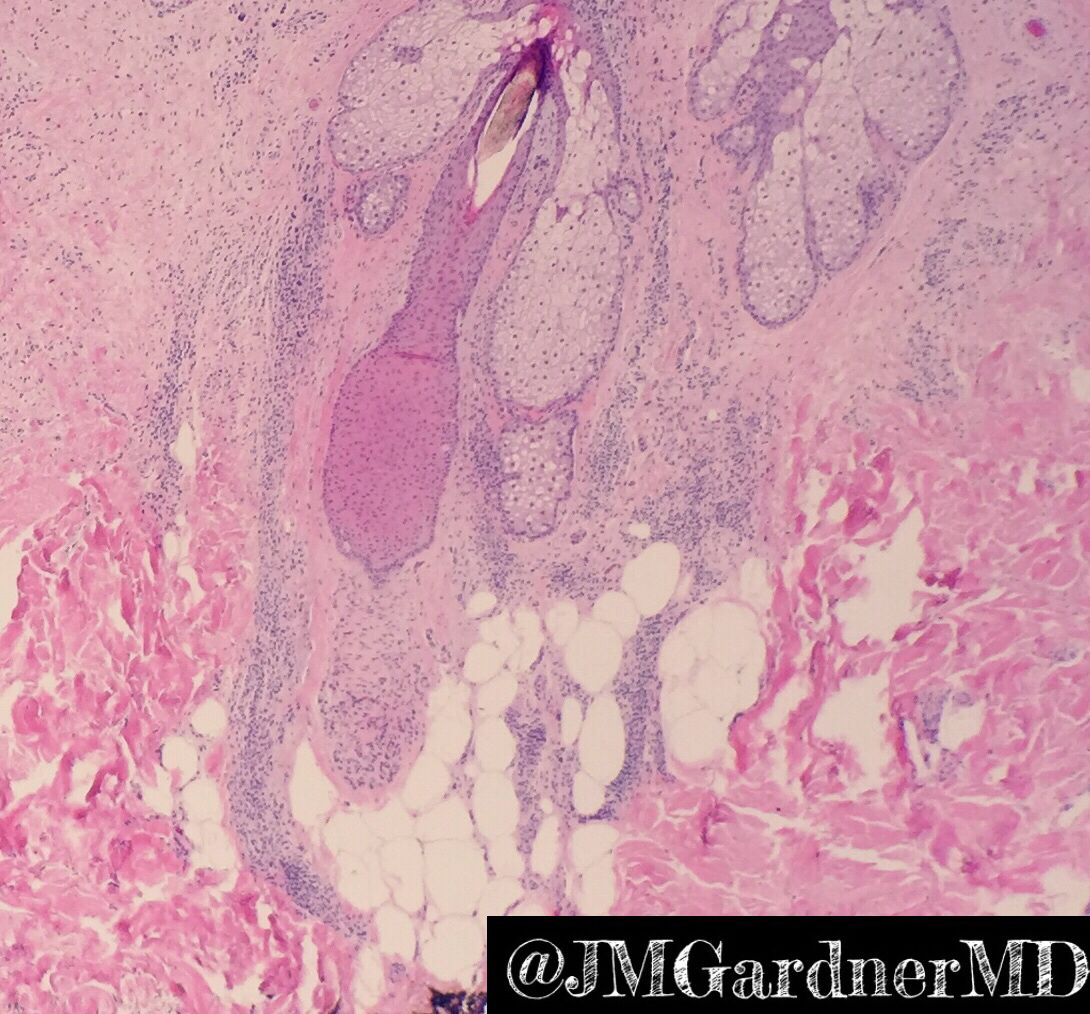 JMGardnerMD's tweet photo. Congenital nevus. Bland melanocytes track around hair follicles and other adnexae. Also track nerves &amp; blood vessels (not shown). #dermpath #Pathology #dermatology https://t.co/kIhbetxt2D