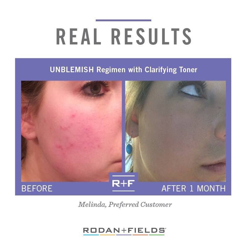 abkduran3's tweet image. Breakouts? You can say &quot;peace out&quot; to breakouts with UNBLEMISH. Unblemish combats the entire acne cycle and unclog pores, clears blemishes, and will calm your complexion. You don&apos;t have to live with acne!