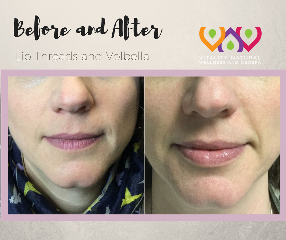 VitalityNatWell's tweet image. Beautiful natural lips are possible with Smooth Threads and a bit of filler! #smooththreads #lipenvy #lips #beauty #women
