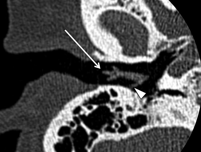 ASNRographics's tweet photo. Inner ear... check!  Middle ear... check!  External ear… maybe it’s time for a review. Read the latest #Neurographics article here: https://t.co/nS0gfXOW45. #neurorad https://t.co/AX4yn7dimU