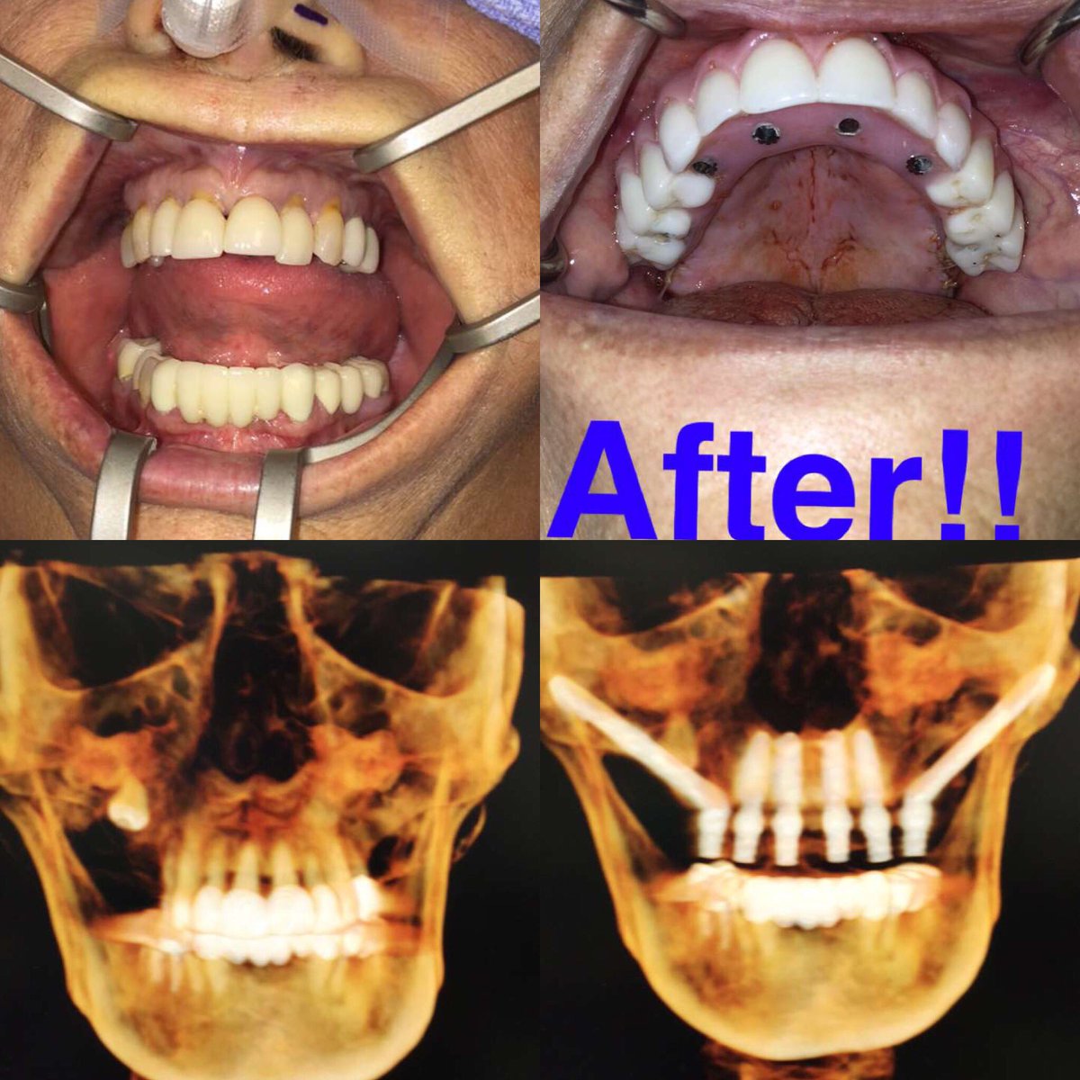 therealfacedoc's tweet image. Failing maxillary dentition...last resort, dentures or implants. #noBone #zygomaticimplants #dental #implants #teeth #newteethnow @newteethnow #therealfacedoc #fixedbridge