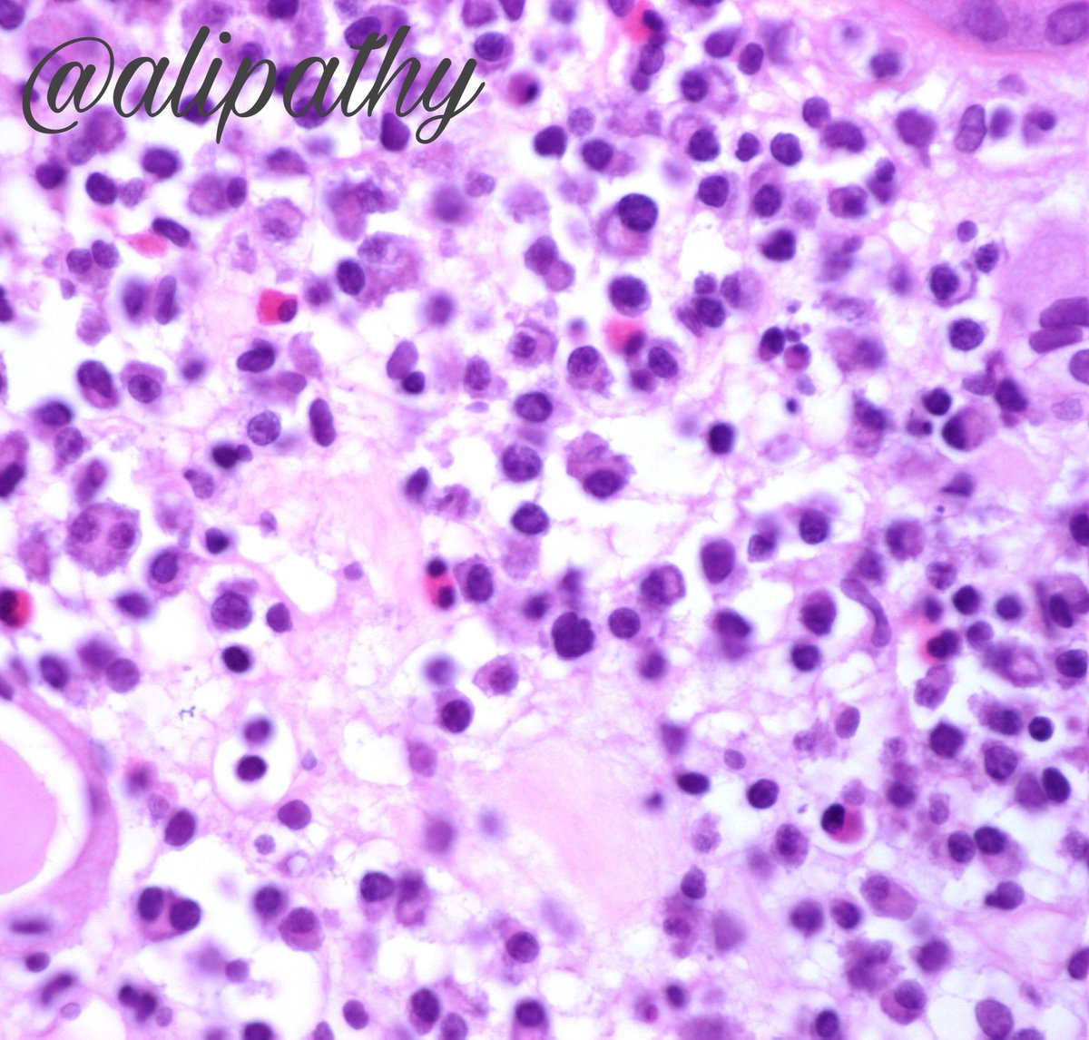 Alipathy's tweet photo. Love this old case: Tubulointerstitial nephritis-IgG4 related. Histopathologic, immunophenotypic, radiographic and serologic findings, clinical outcomes, including response to therapy is needed to diagnose this! #renalpath #Kidney #nephrology #pathology https://t.co/VCXOpEwA9C