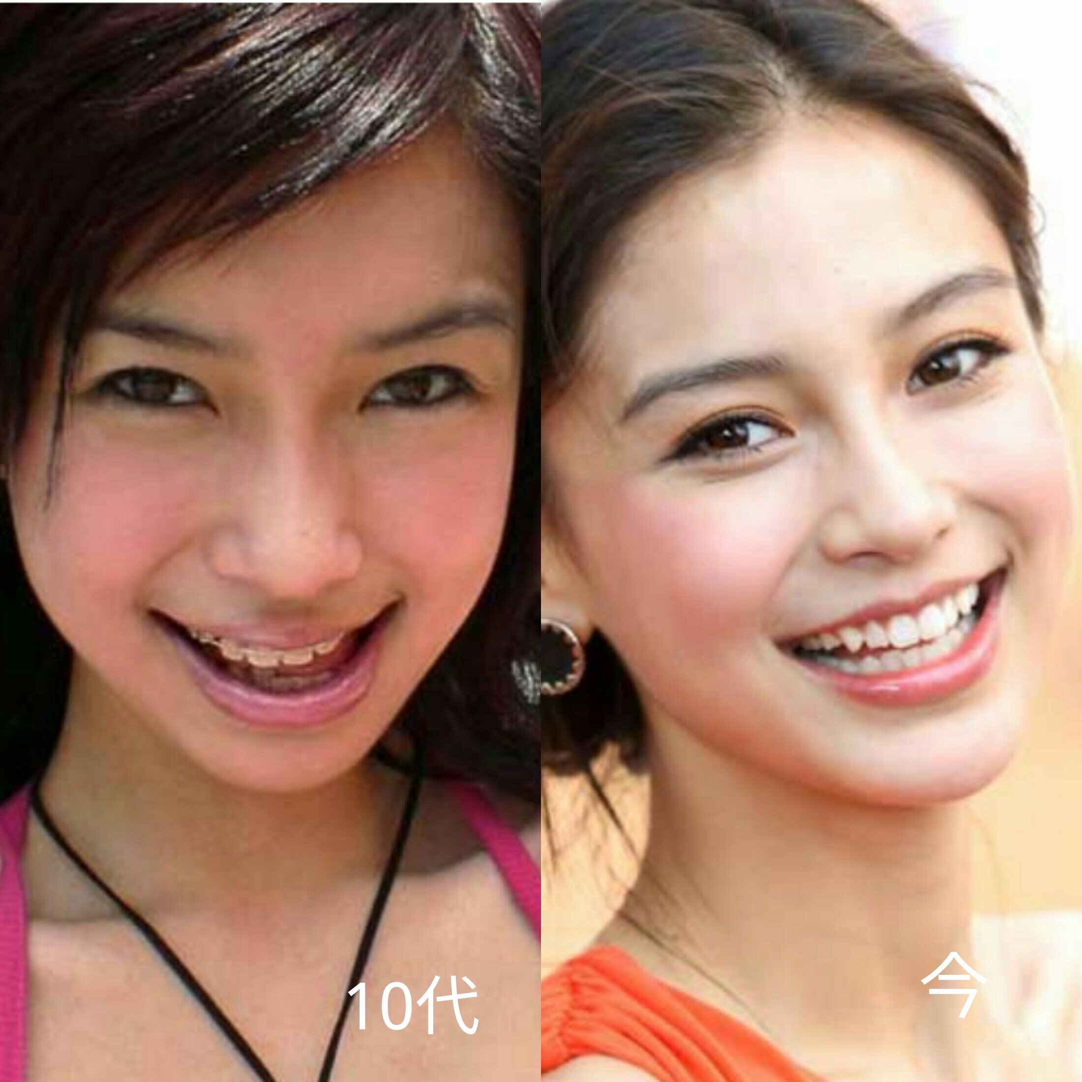 アンジェラベイビー アンジェラベイビーの顔面変化 抜歯込みの歯列矯正が、顔に大きな影響を与えたようだ。 アンジェラベイビーは2015年、美容整形疑惑を晴らすため、中国の権威ある病院で検査をし、X線写真を確認して「天然美女」と証明した。しかし、台湾の別の美容  ...