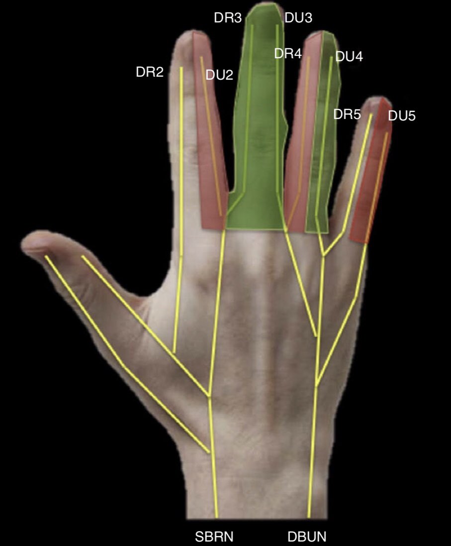 Dr_Corella's tweet photo. Hemos publicado estudio anatómico sobre la seguridad de los portales metacarpofalángicos
El tercer dedo es el más seguro, el lado ulnar del segundo y radial del cuarto son los que tienen riesgo más alto de lesión nerviosa.
https://t.co/w5C21zLDXY https://t.co/4IQn9UpTh3