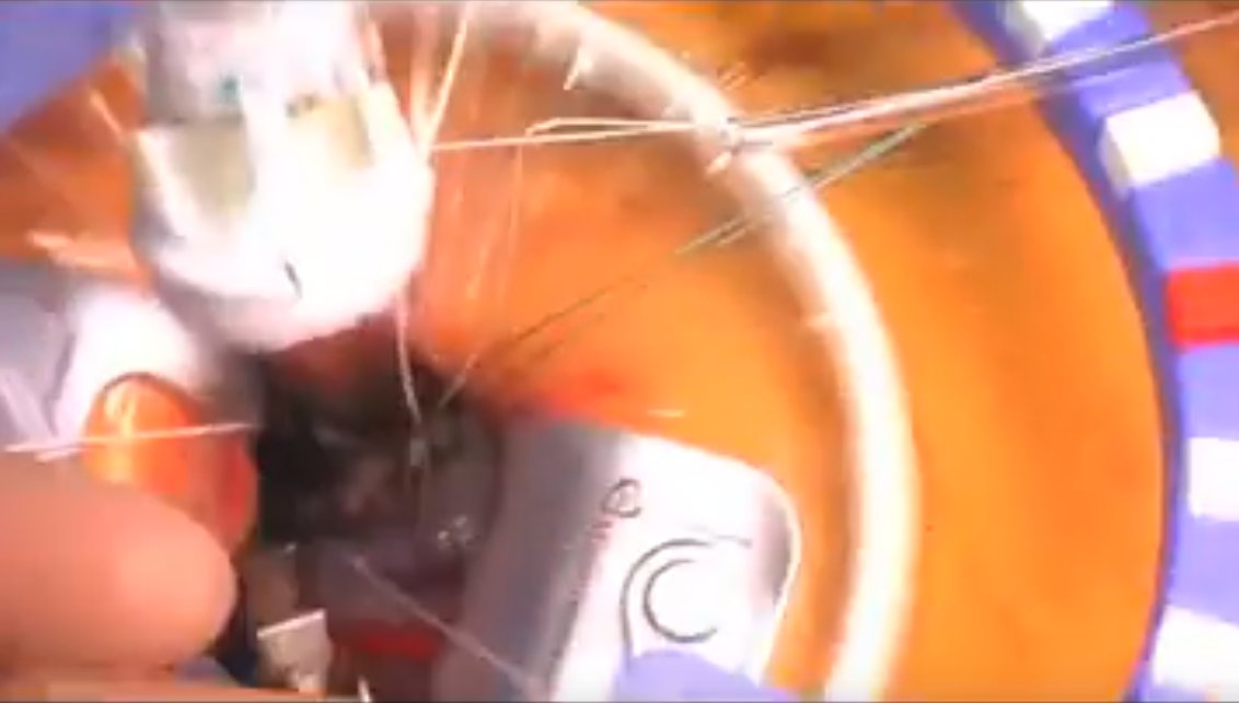 ctsnetorg's tweet photo. New on CTSNet: Right Anterior #Minithoracotomy #AVR Intuity #Valve for Bicuspid Aortic #Stenosis #tssmn #ctsurgery #Aorta https://t.co/387ZTc76SL https://t.co/zZlZ59DxDc