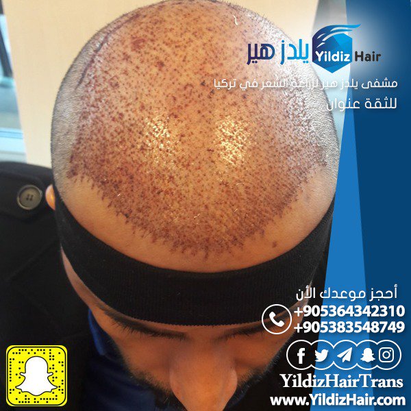 yildiz_hair's tweet photo. استعد شبابك معنا على يد أمهر #أطباء في #زراعة_الشعر في #تركيا، نتائج مضمونة 💯
🚩للتواصل: (00905364342310) 📲
🔥واتساب مباشر : ( https://t.co/aNHt6Cr32L ) 📲
.....................................
#زراعة_اللحية #زراعة_الشعر #زراعة_الذقن #زراعة_الشعر_في_تركيا #تركيا #اسطنبول https://t.co/ZxzrEnKZH1