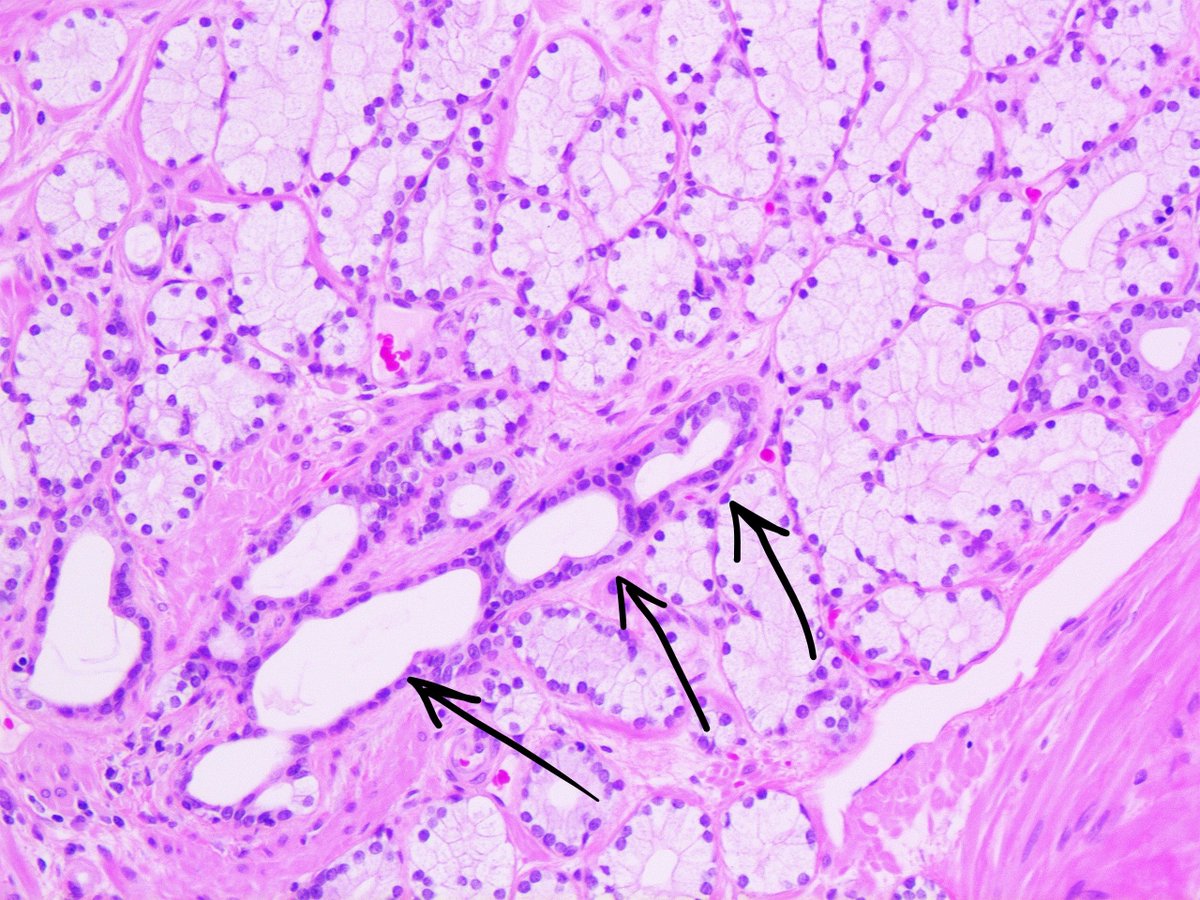 foamy gland adenocarcinoma prostata